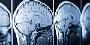 Image of multiple brain MRI scans